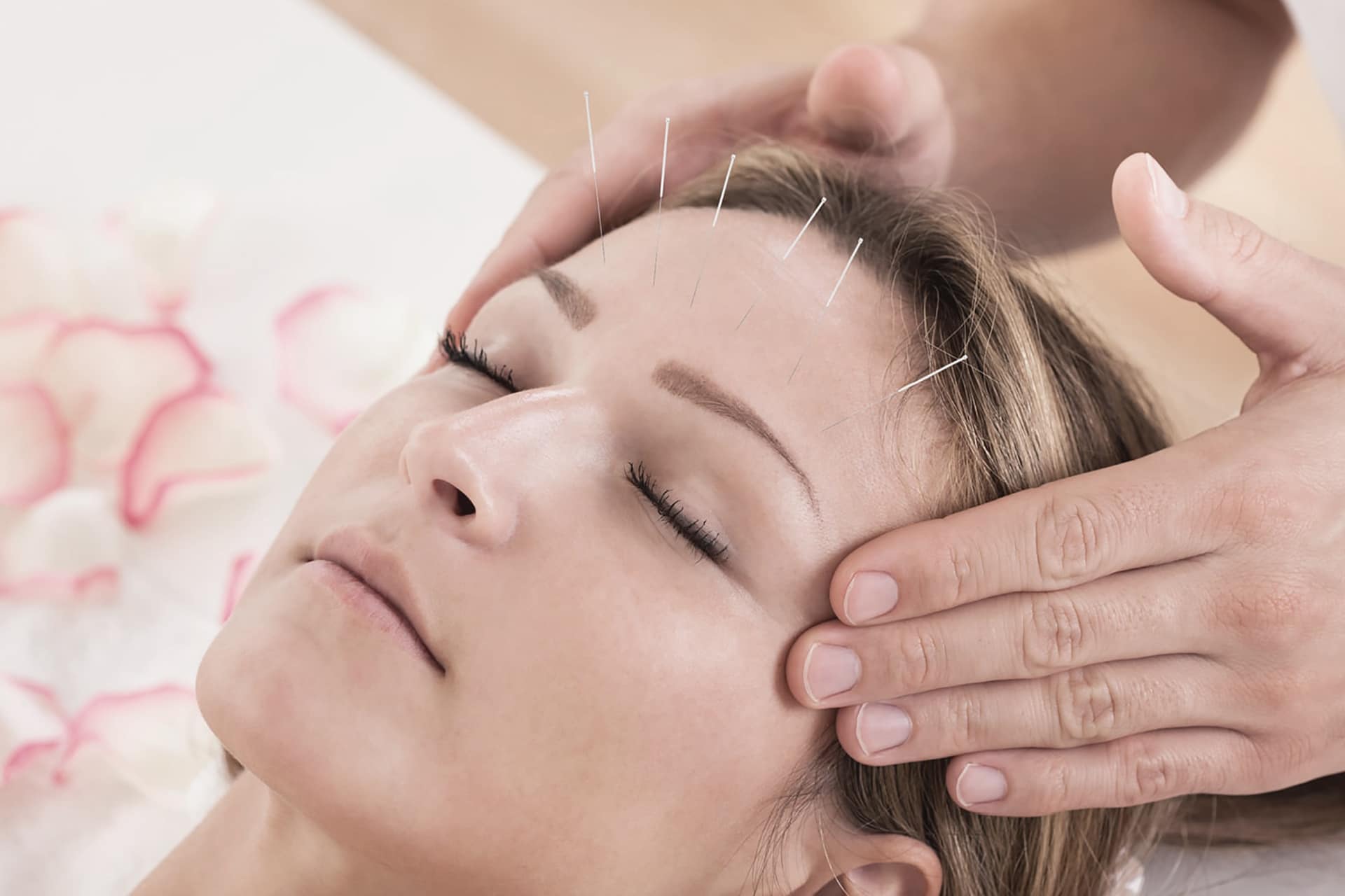 acupuncture for migraines