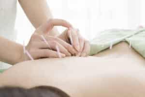 acupuncture needles in woman for back pain